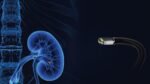 Video Ureteroscopio Flexible - Imagen 2